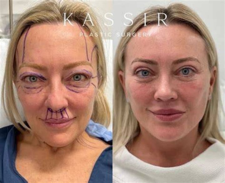 Alabama Barker Claps Back at Cosmetic Surgery Claim: ‘I’m Natural, Besides My Lips’
