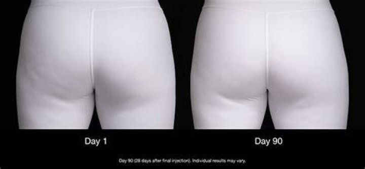 Best Cellulite Treatment For Butt & Thighs – Expert Tips – Hollywood Life