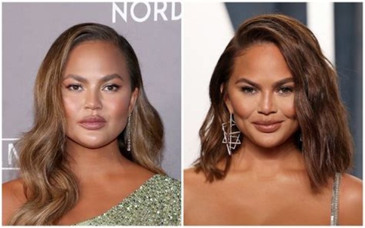 Botox For Migraines: Chrissy Teigen & More Celebrity Supporters