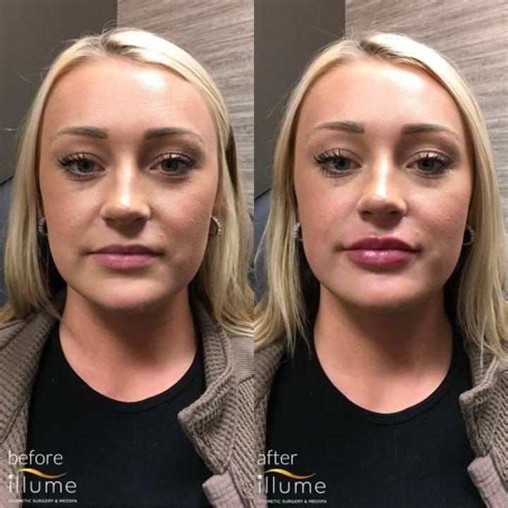 Brielle Biermann, 22, Shows Off Smaller Lips After Saying That She’s Done With Fillers – Pic