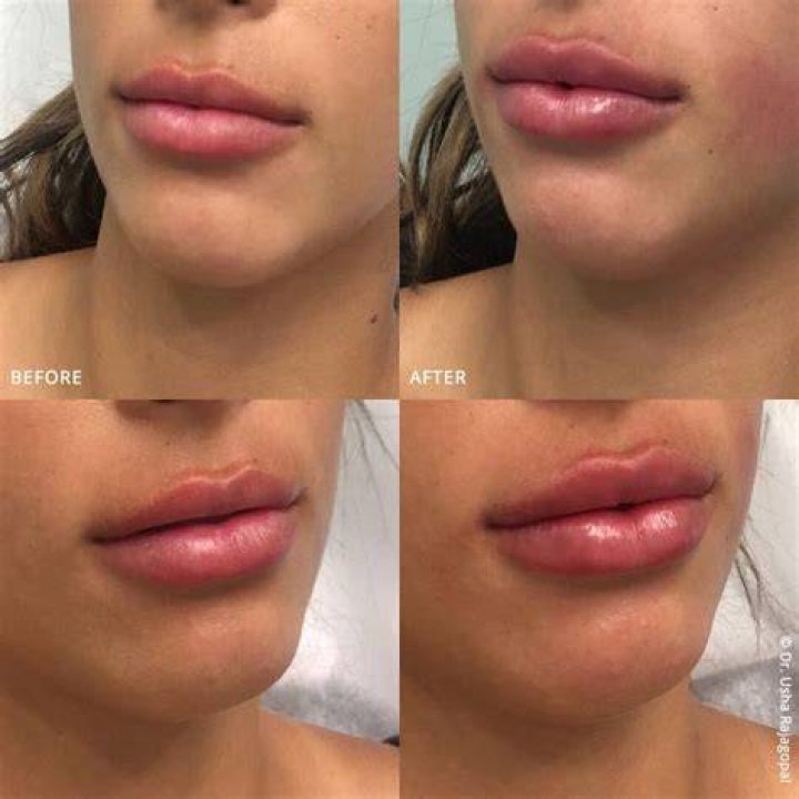 Brielle Biermann Reinjects Lip Fillers 1 Month After Dissolving Them – ‘I Couldn’t Be Happier’