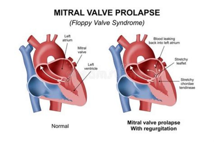 Carol Barr’s Death At 39: Why Floppy Valve Syndrome Killed Her Even Though It’s ‘Not Usually’ Fatal — Cardiologists