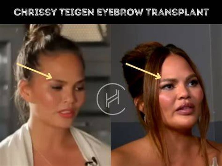 Chrissy Teigen Confesses She’s Having Her Implants Removed: ‘I’m Just Over It’