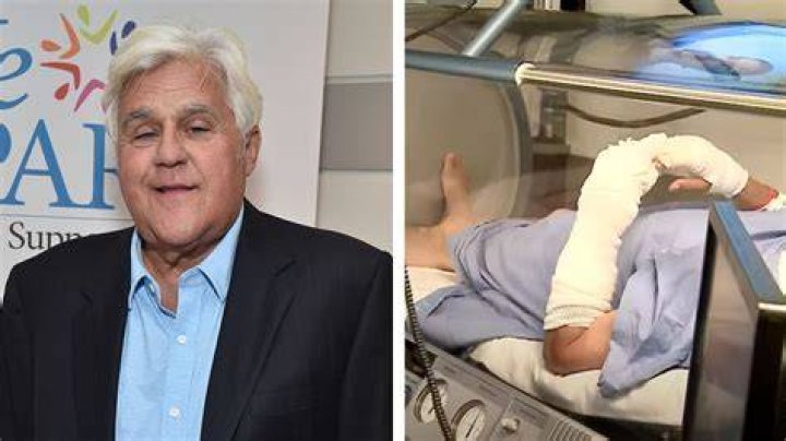 Jay Leno Reveals He Broke Multiple Bones In Motorcycle Accident 2 Months After Getting Burned In Fire