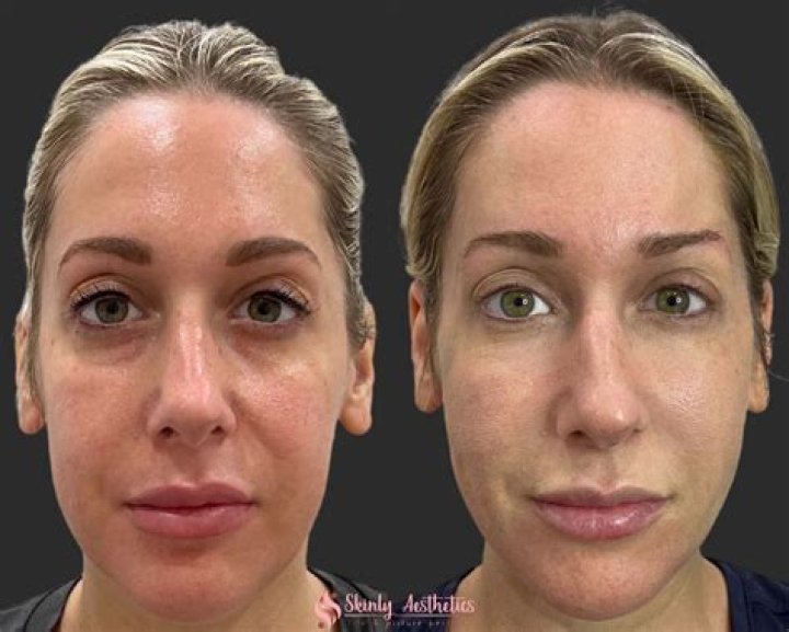 Lip & Cheek Fillers — Doctors Speak – Hollywood Life