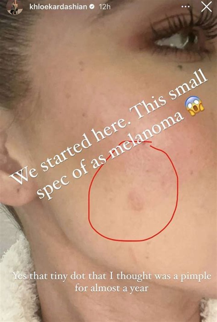 Nurse, 29, Posts Selfie Of Blistered Face To Show Dangers Of Skin Cancer Inspires Others