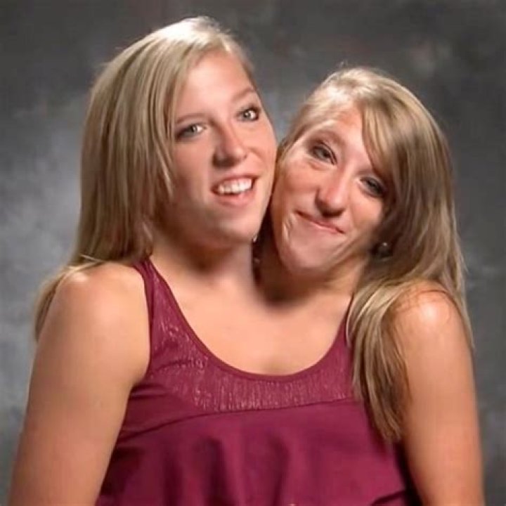 [PICS] Conjoined Twins Erin & Abby Delaney – Hollywood Life