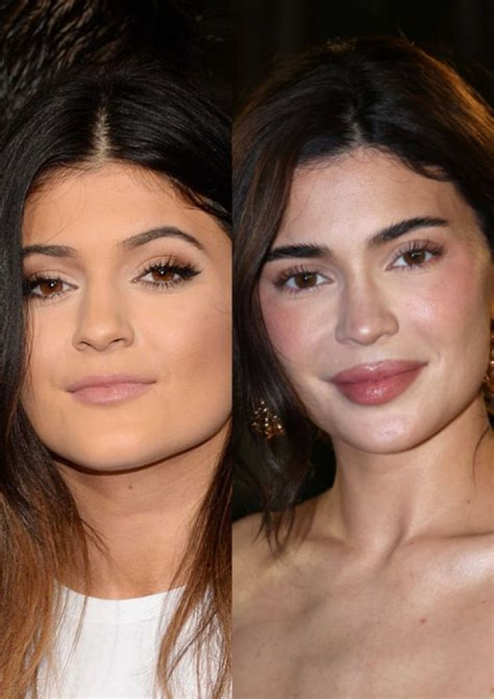 [PICS] Kylie Jenner Gets Lip Injections — Experts Speak Out – Hollywood Life