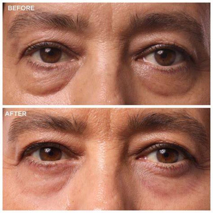 Under Eye Bag Removal — Her Tips – Hollywood Life
